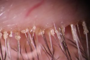demodex