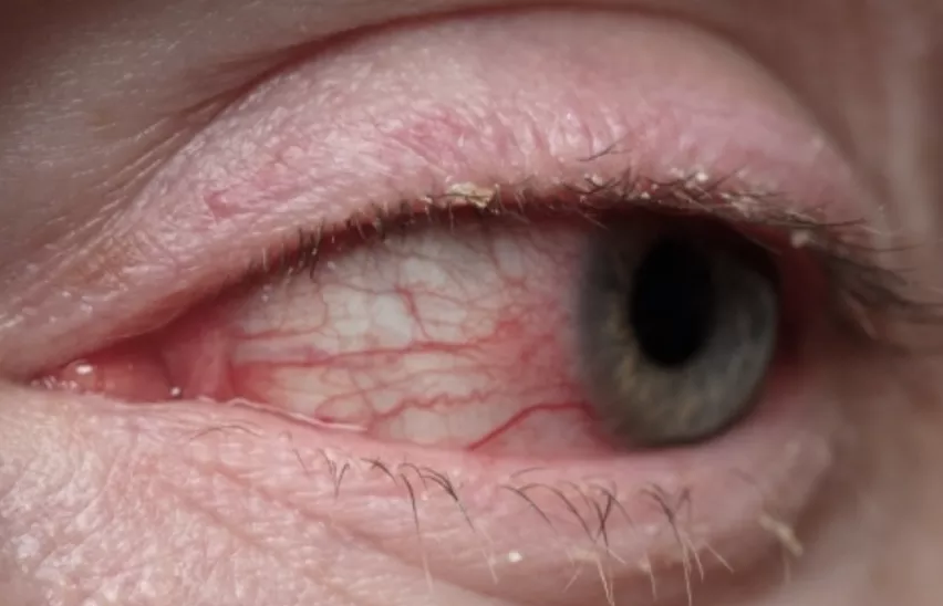 Rougeur bulbaire
